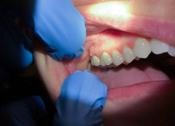 Best Broken Tooth Emergency  in Canfield, OH