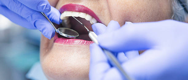 Emergency Dental Filling Replacement in OH