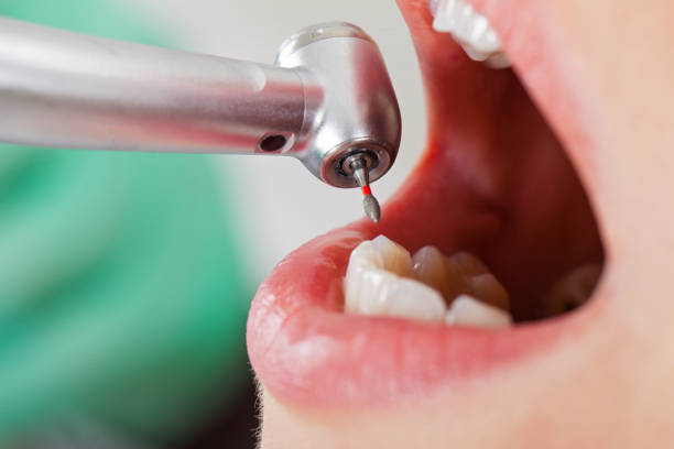 Best Urgent Tooth Repair  in Canfield, OH